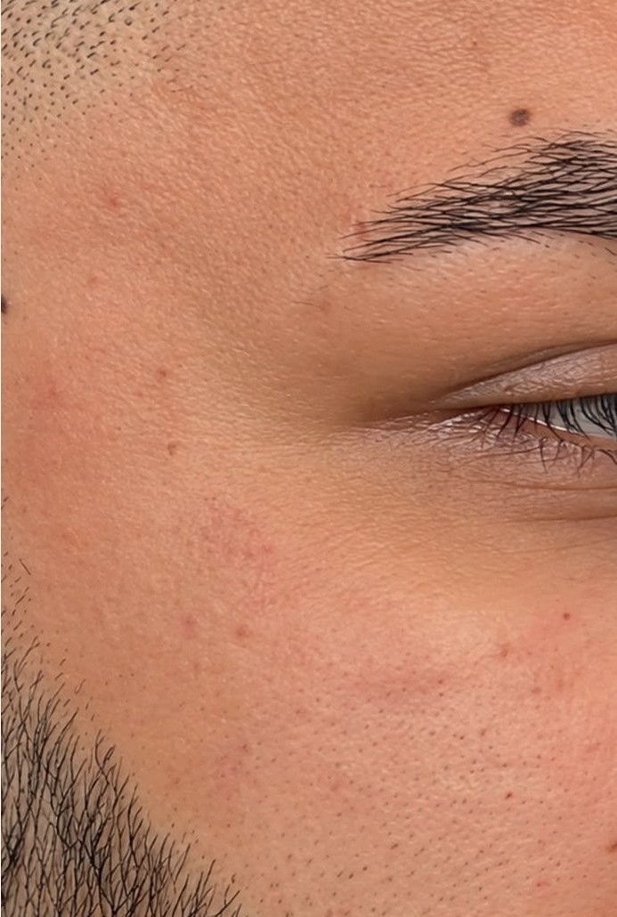 After microdermabrasion: calmer, clearer skin