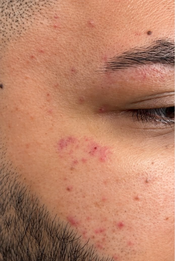 Before microdermabrasion: breakouts and redness on the cheek